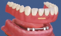 4 impianti dentali e protesi con barra