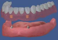 Dentiera fissata su una sovrastruttura a palla fissata su due impianti