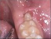 Ínnyel fedett bölcsességfog