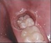 Rádiósebészeti módszerrel felszabadított bölcsességfog