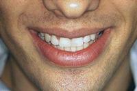 Closed gaps with filling material