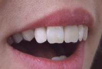 Koronához előkészített fogak