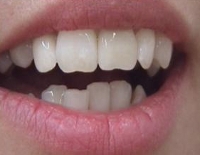 Fogazat Empress koronákkal