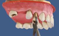 Bone preservative extraction