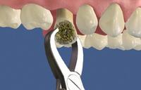 Estrazione del dente