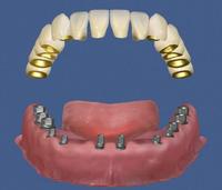 Dentistinhungary - l'implantologo