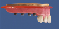Ponte dentale sull'impianto
