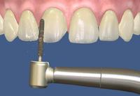 Veneer step by step