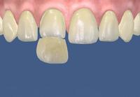 Veneer step by step