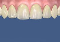 Veneer step by step