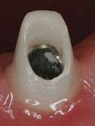 Zirconia abutment for zirconia crown